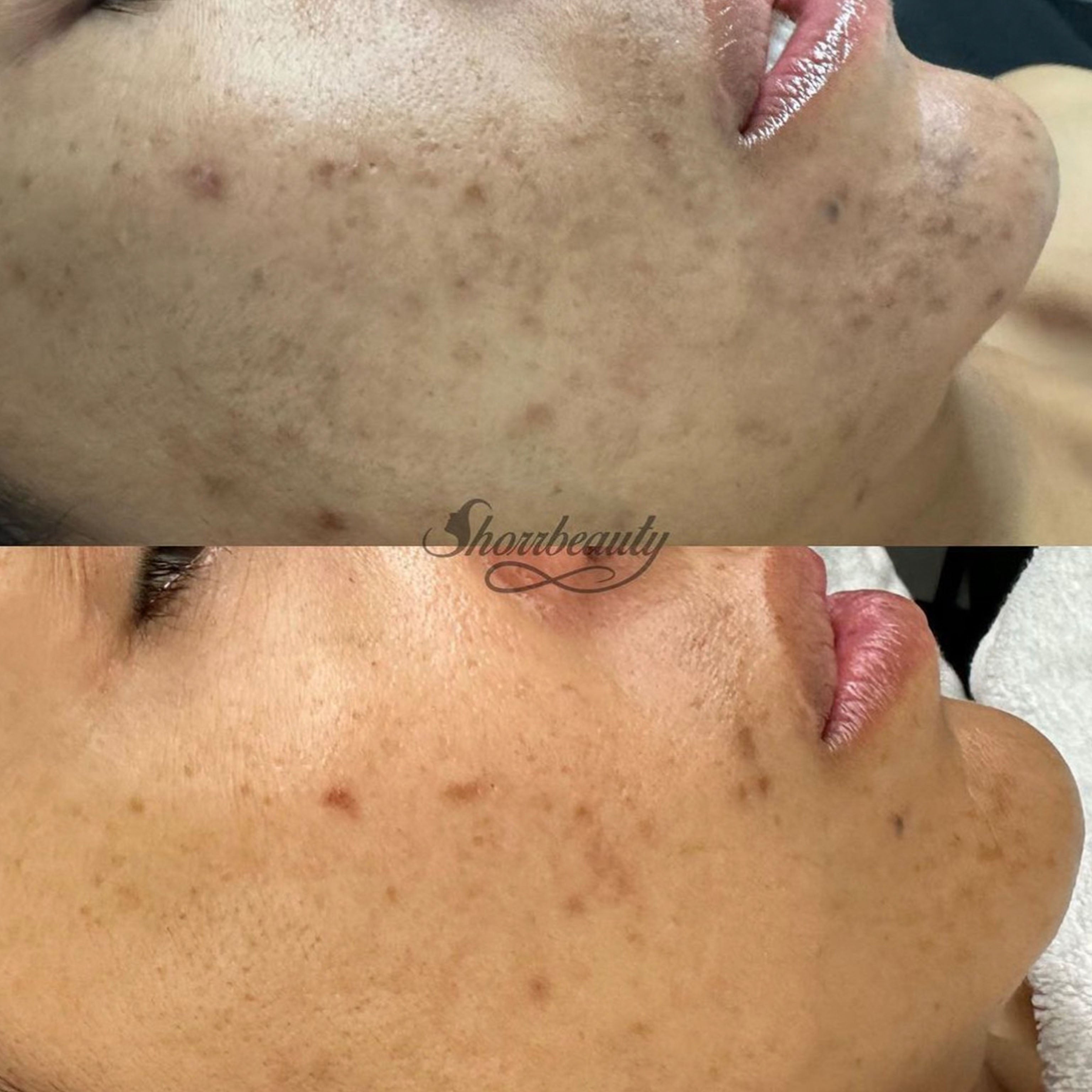 biorepeel applied to face before and after