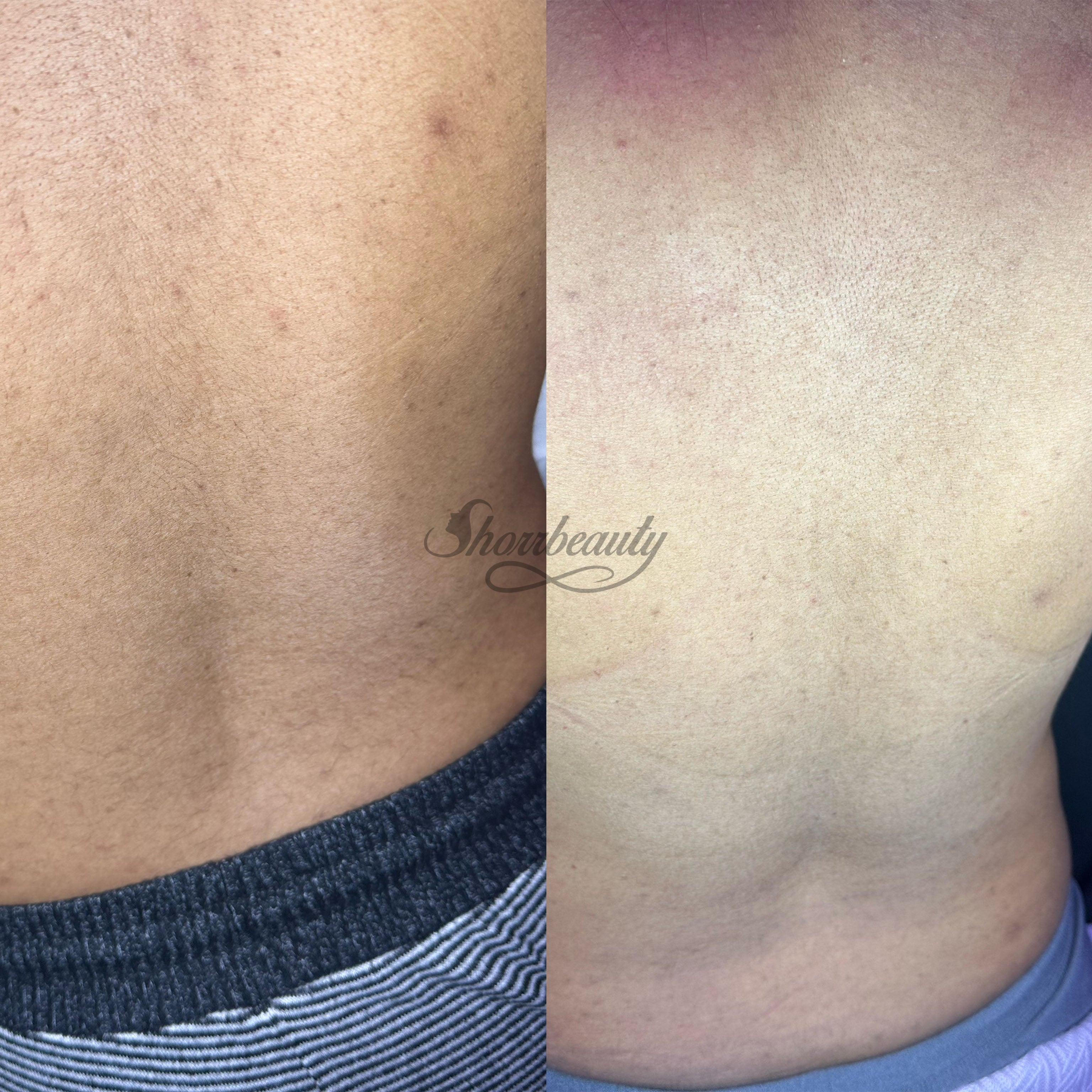 biorepeel applied to back before and after