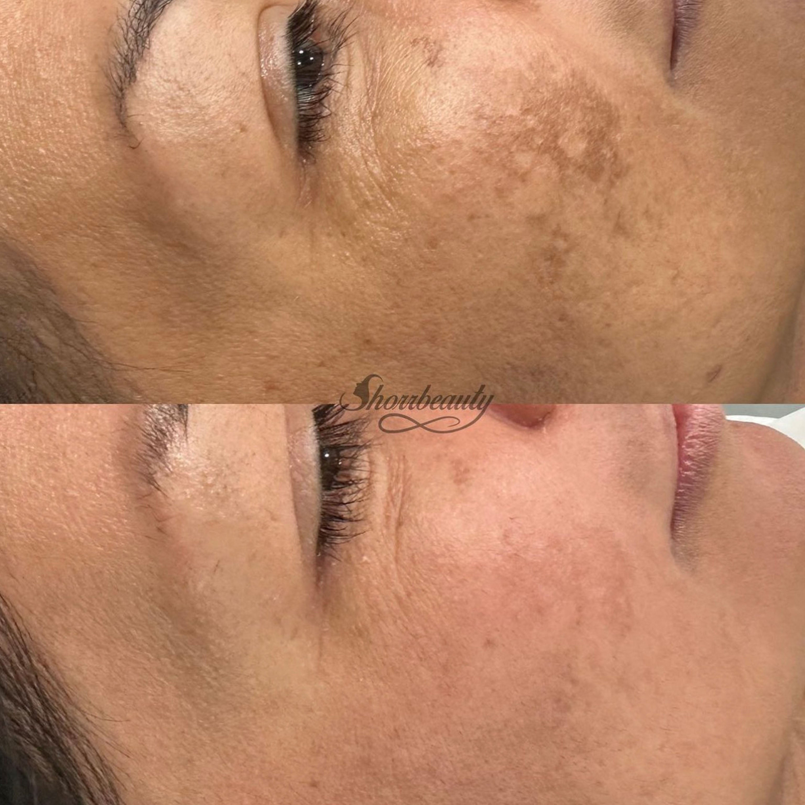 before and after of cosmelan for melasma