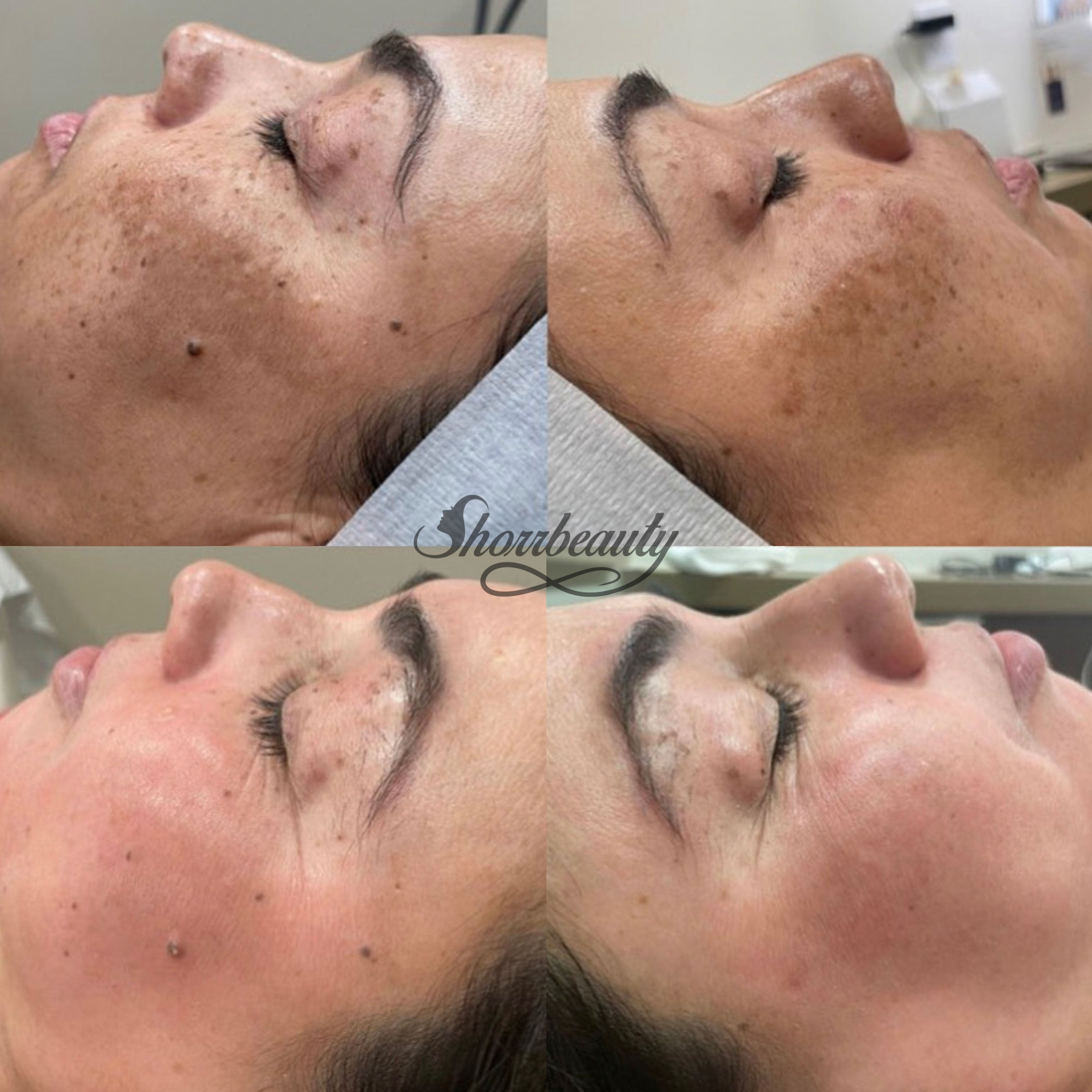 before and after of cosmelan for melasma