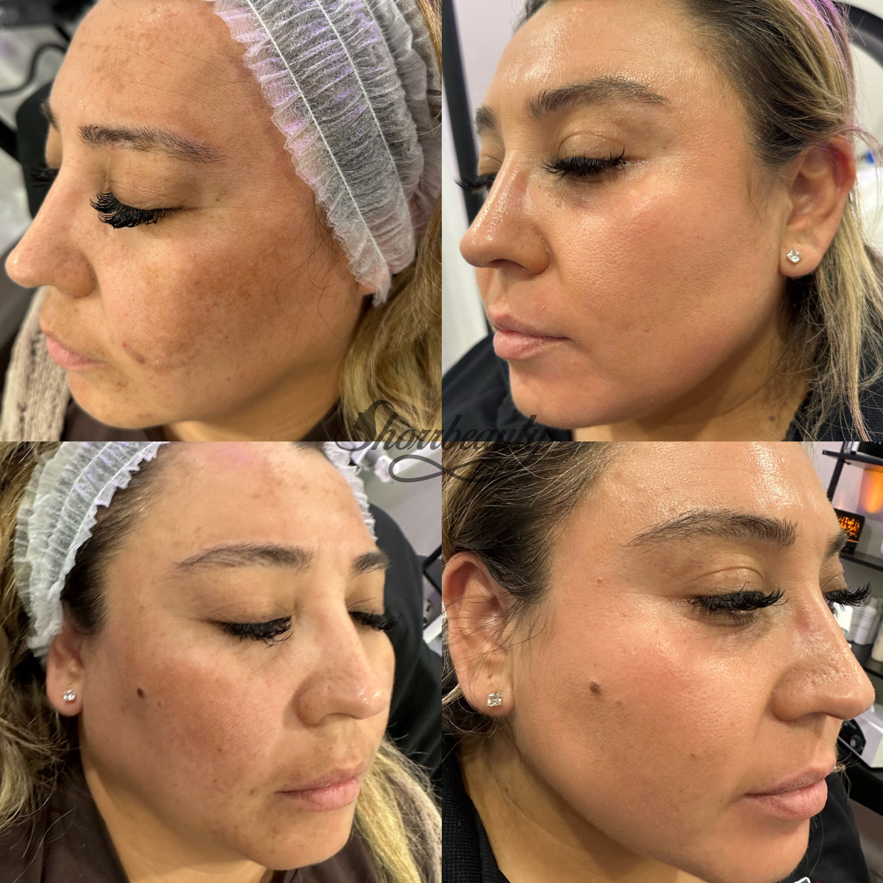 before and after of cosmelan for melasma