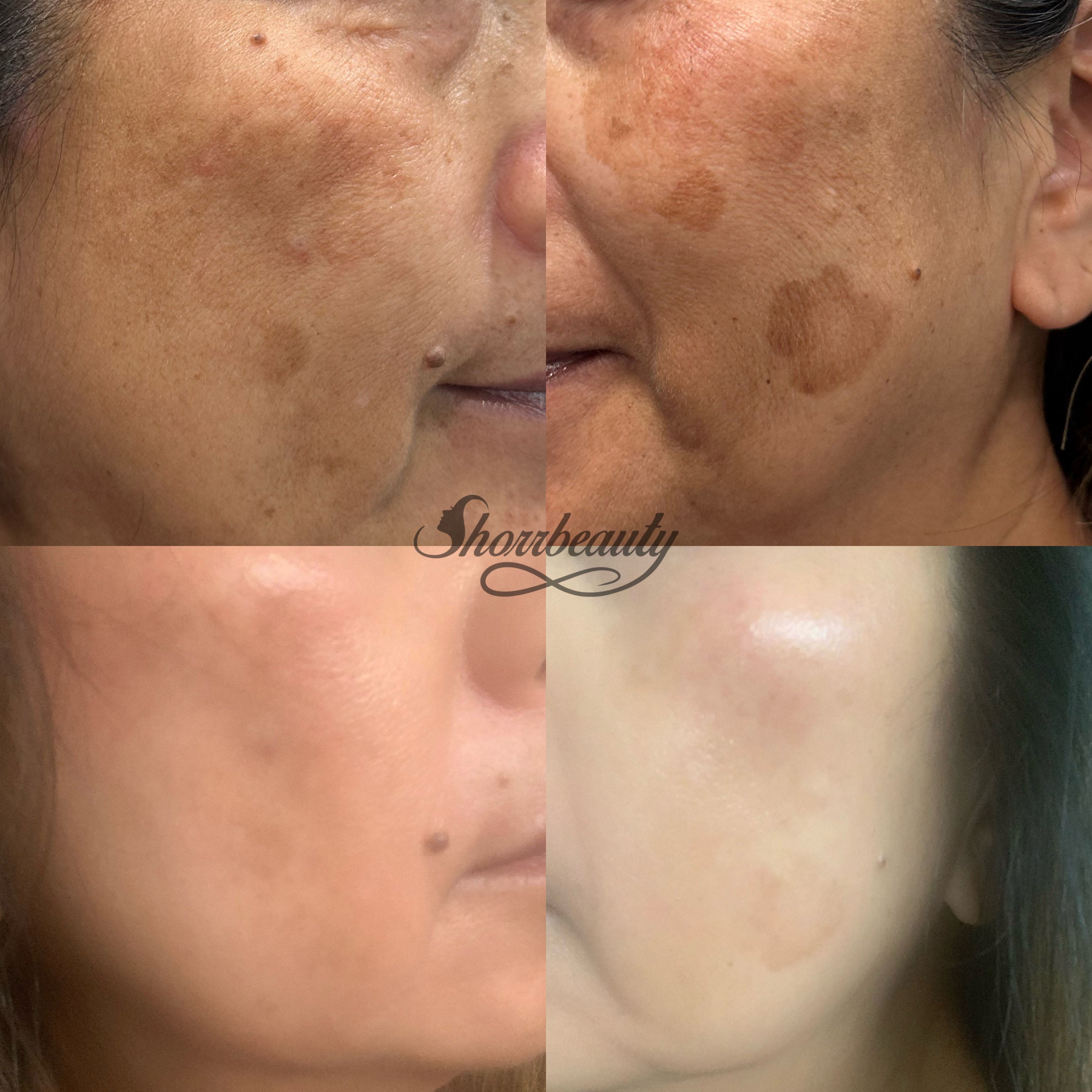 before and after of cosmelan for melasma