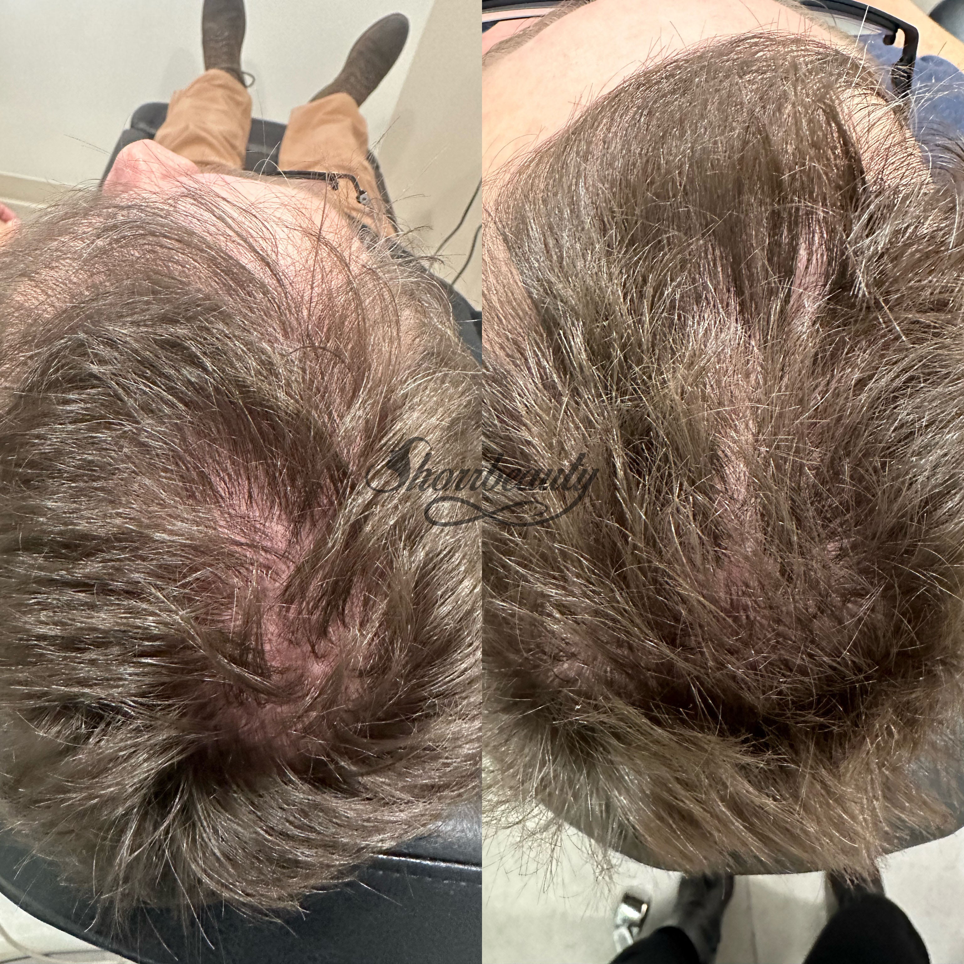 mens hair rejuvenation before and after shorrbeauty costa mesa california