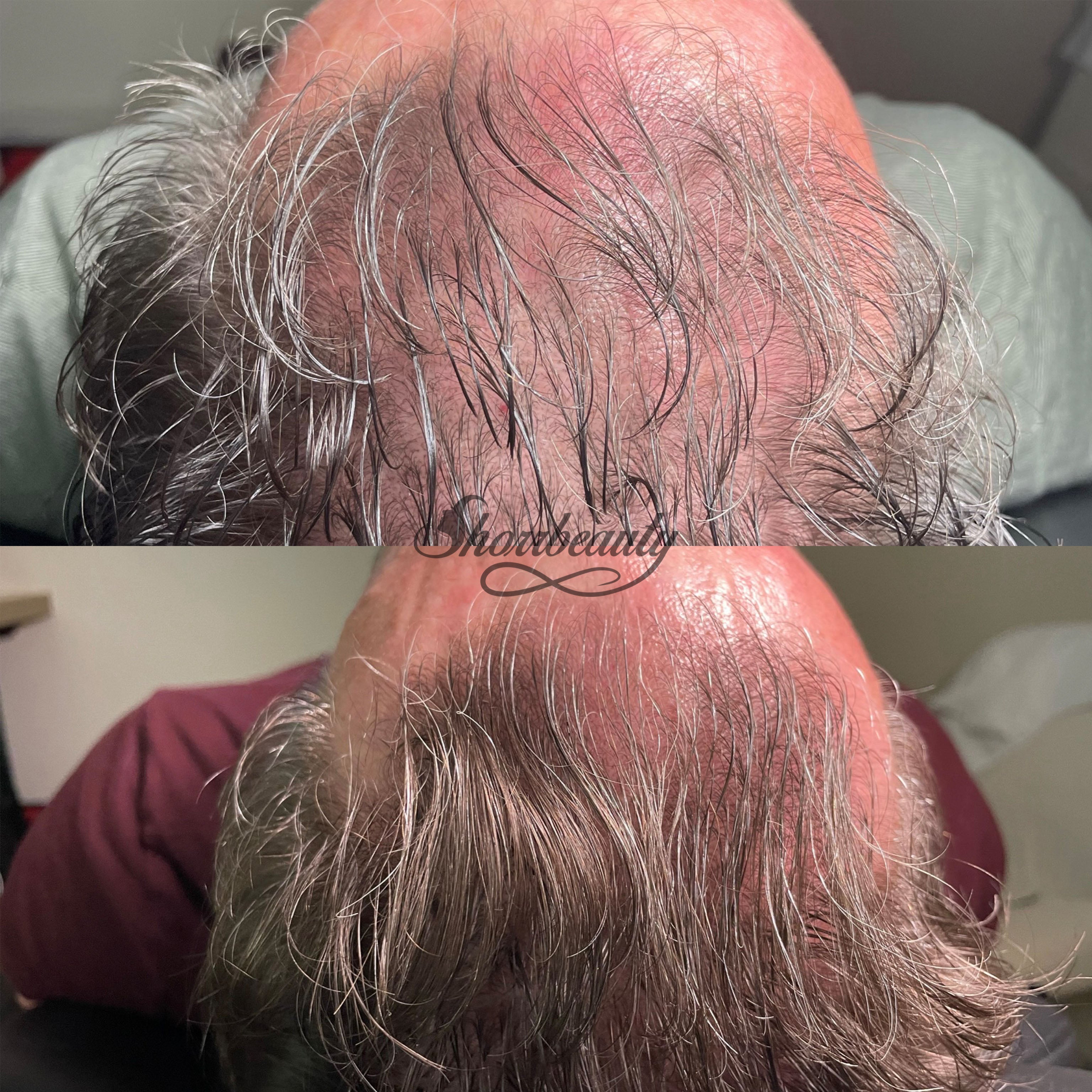 mens hair rejuvenation before and after shorrbeauty costa mesa california