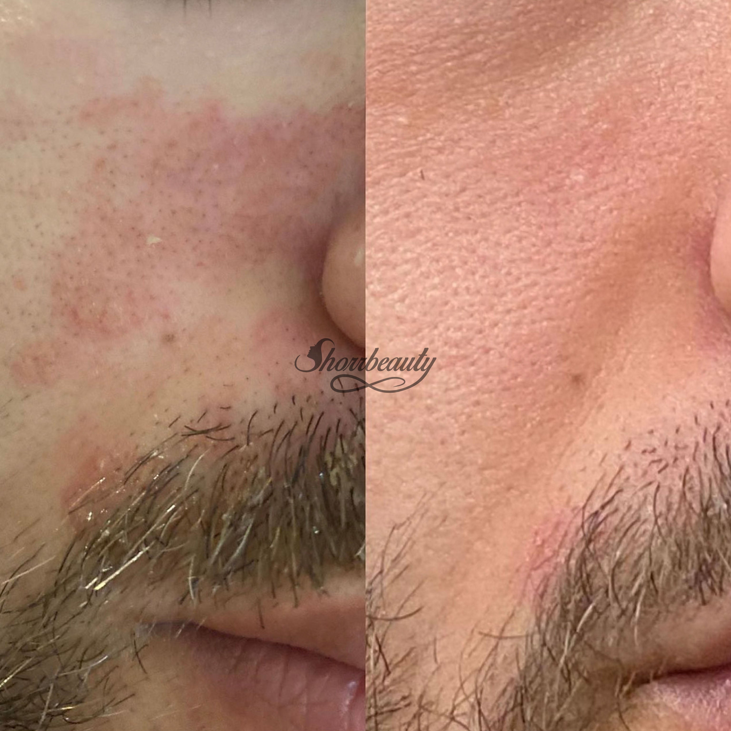 microchanelling before and after on face