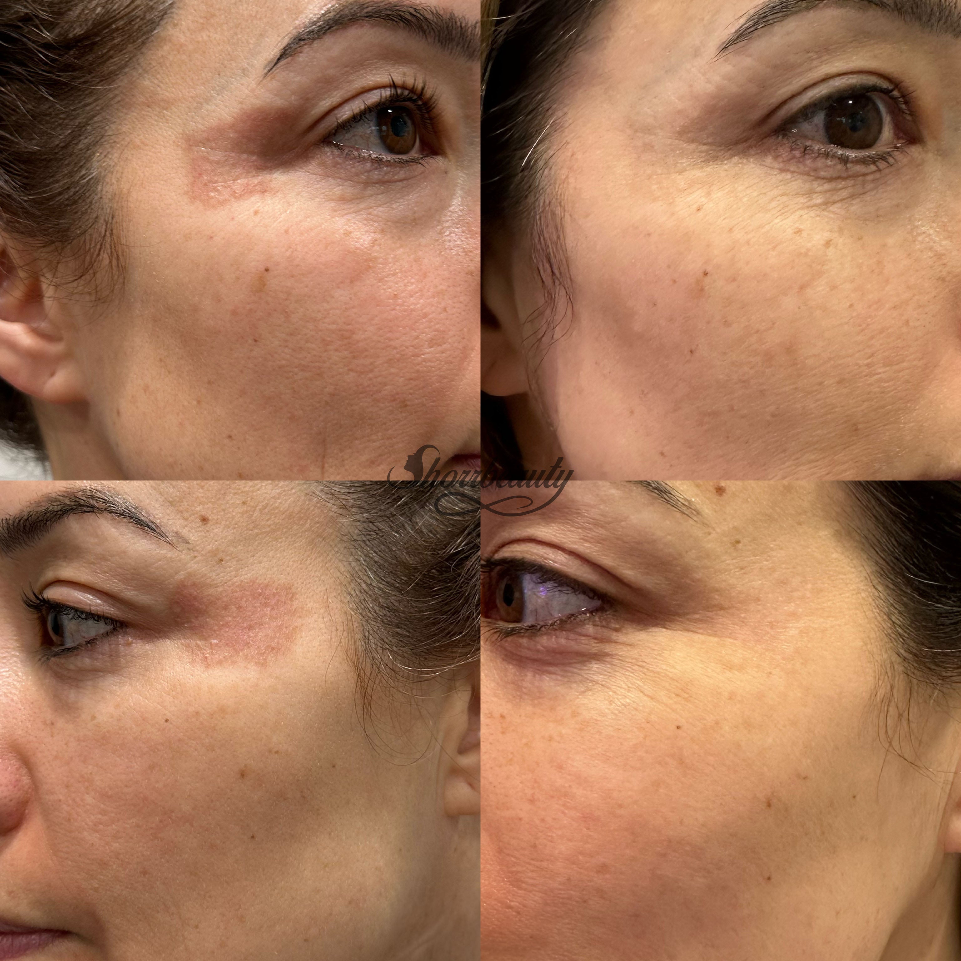 microchanelling before and after on face