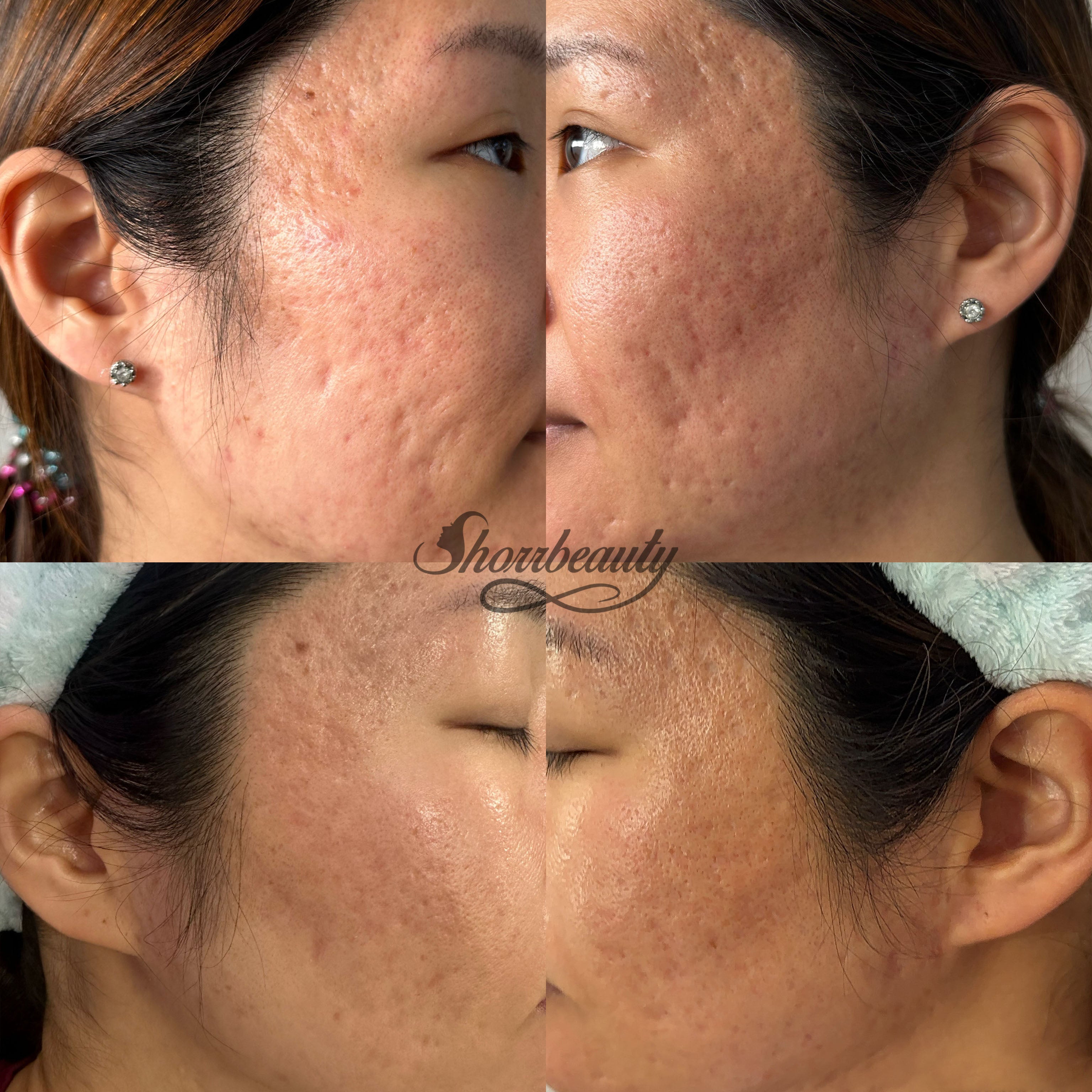 microchanelling before and after on face