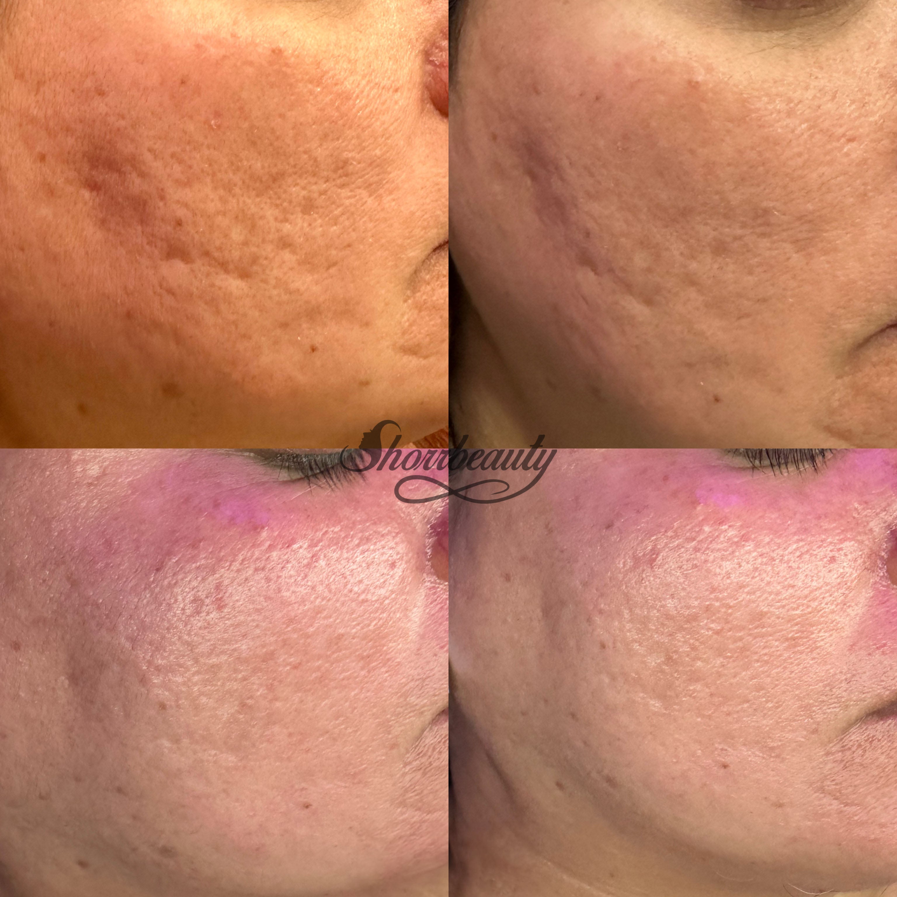 microchanelling before and after on face