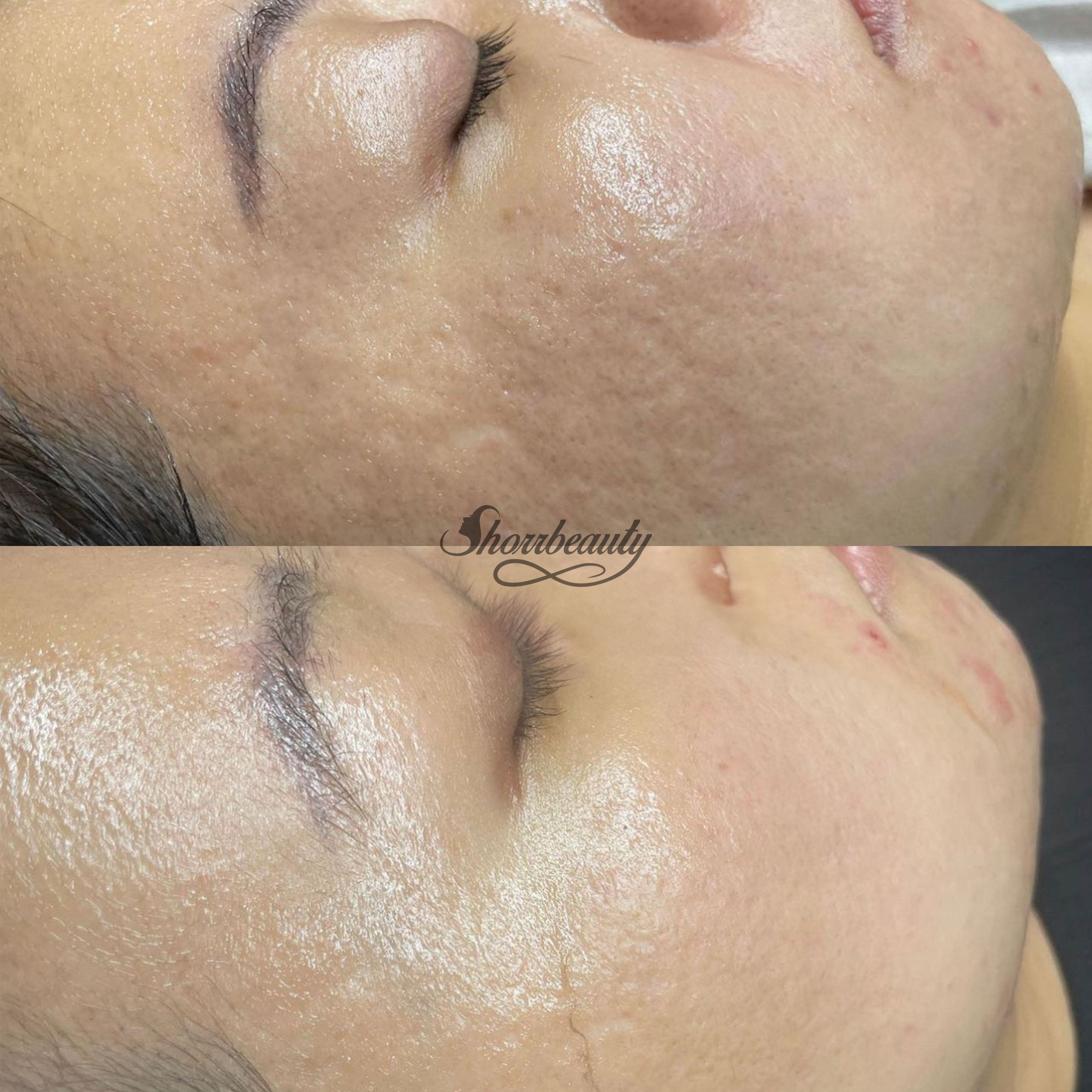 microchanelling before and after on face