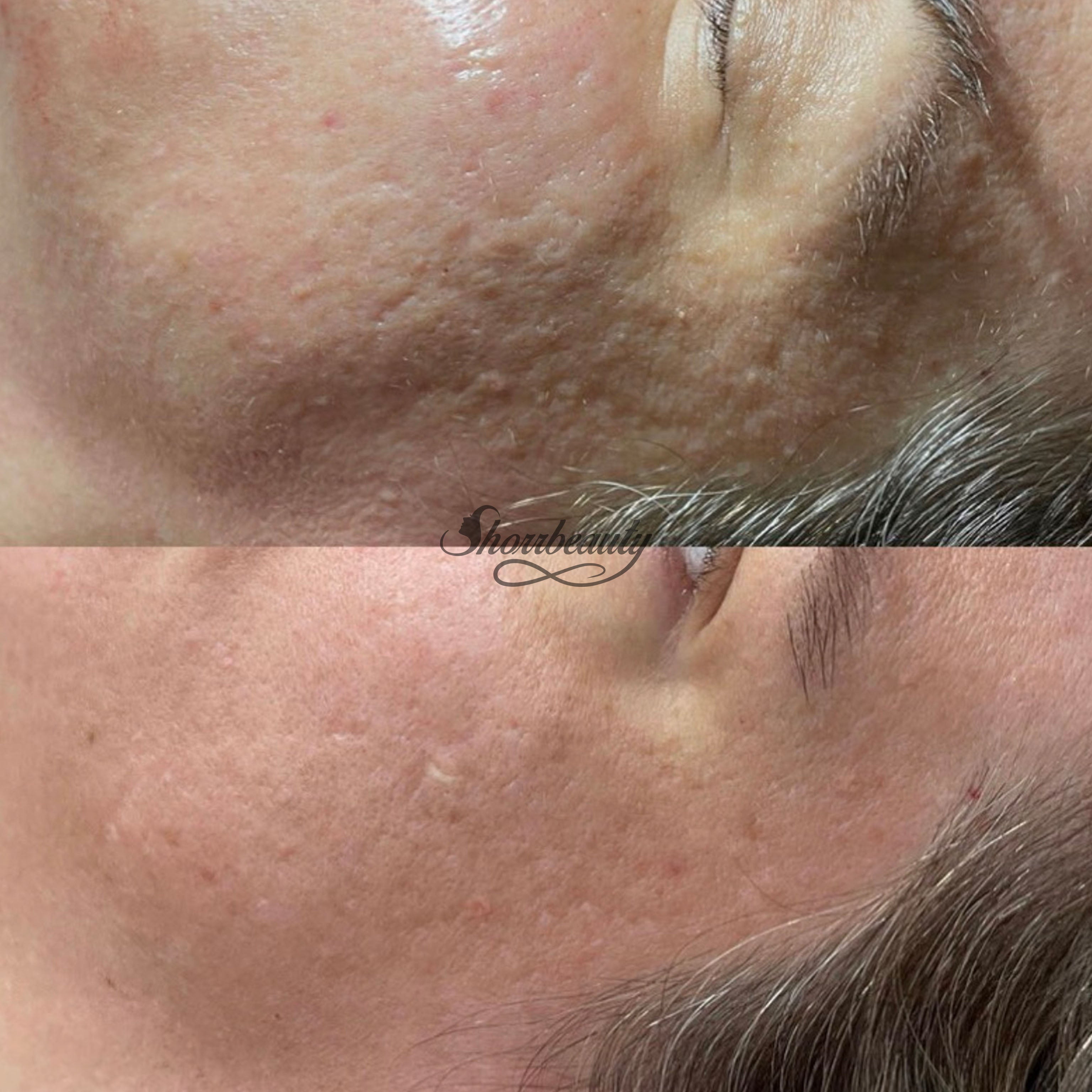 microchanelling before and after on face