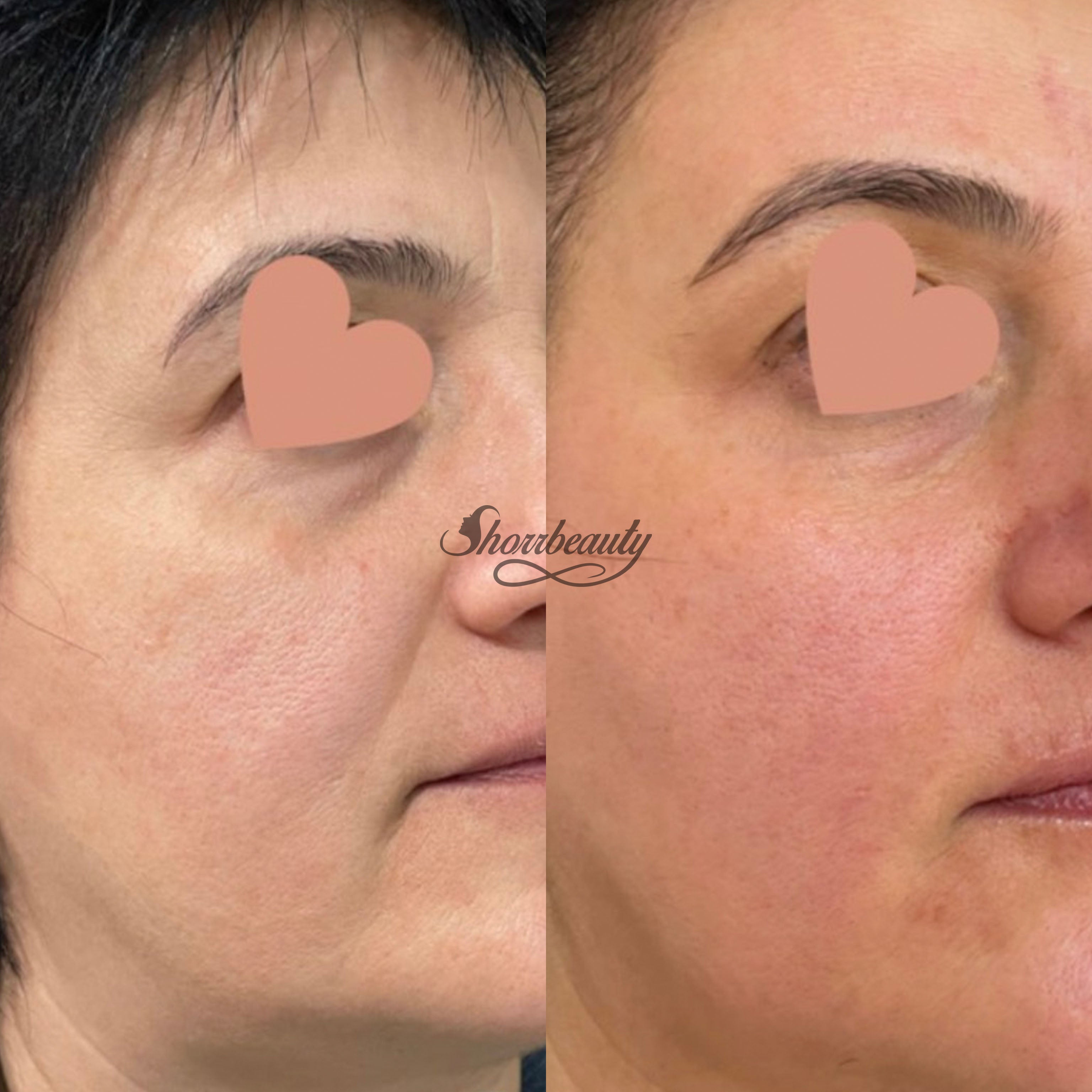 microchanelling before and after on face