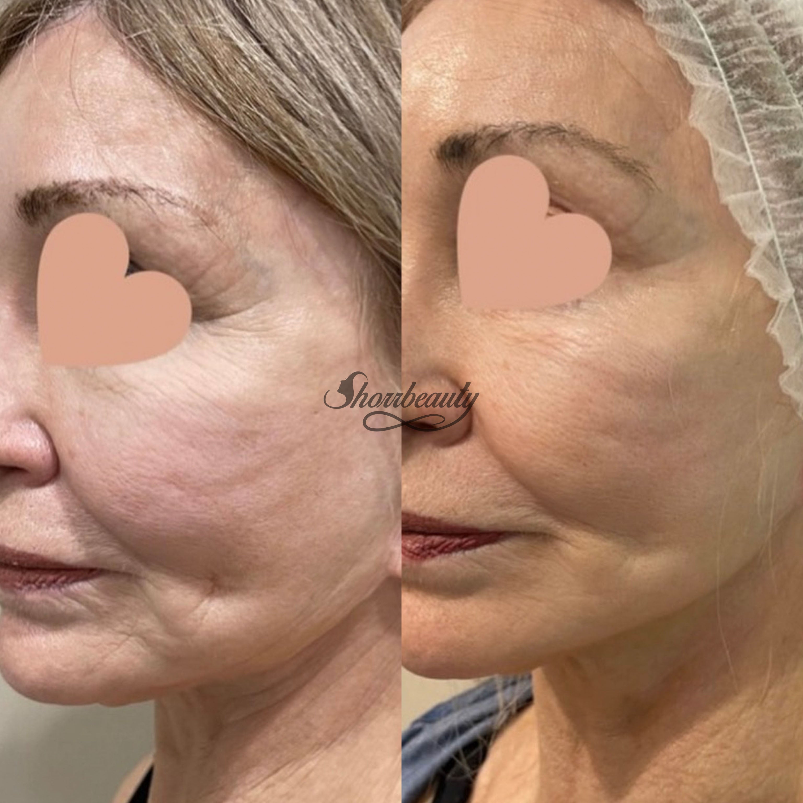 microchanelling before and after on face